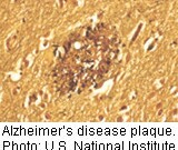 AAIC: Hints That New Drug May Slow Alzheimer’s Progression A drug called solanezumab may slow Alzheimer's disease progression by about one-third