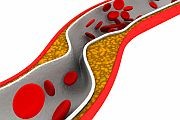 Paclitaxel-Coated Balloon Found Superior in Femoropopliteal PAD For patients with symptomatic femoropopliteal peripheral artery disease