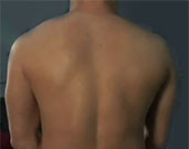 10-kHz Spinal Stimulation Aids Back, Leg Pain High-frequency spinal cord stimulation is superior to conventional lower-frequency treatment for relief of chronic back and leg pain