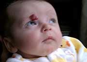 Propranolol Effective for Infantile Hemangioma Propranolol (Inderal) appears to be effective in treating infantile hemangiomas