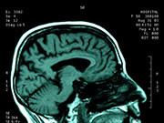 Patients Give Favorable Report of Epilepsy Surgery More than nine in 10 epilepsy patients who had brain surgery to try to control their seizures are happy they did so