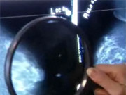 Adding Benign Breast Dz to Risk Model May Boost Preventive Care Greater numbers of high-risk women eligible for primary prevention of breast cancer are identified by incorporating benign breast disease diagnoses into the Breast Cancer Surveillance Consortium risk model