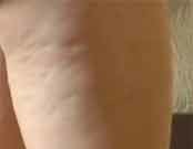 No Single Effective Treatment for Cellulite Identified A comprehensive literature review analyzed the range of available treatments for cellulite reduction. The results were published online July 6 in the Journal of Cosmetic Dermatology.