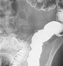 Coalition Calls for Increased Colorectal Cancer Screening Boosting older adults' colorectal cancer screening rates to 80 percent by 2018 would lead to 21