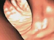 Split-Dose Better Than Day-Before Colonoscopy Prep Split-dose regimens increase the quality of colon cleansing compared to day-before colonoscopy preparation