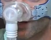 Snoring, Sleep Apnea Linked to Dementia, but CPAP Helps People with sleep-disordered breathing (SDB) may be more likely to develop mild cognitive impairment at younger ages than those without SDB