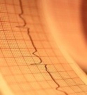 A-Fib Recurrence Common Five Years After Ablation Most patients with atrial fibrillation (AF) and systolic heart failure who undergo ablation have AF recurrence at five years