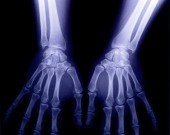 Lasting Outcomes Similar for Carpal Tunnel Release Surgeries For patients with carpal tunnel syndrome
