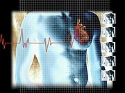 Sports Participation Seems Safe for Children With LQTS There is no evidence of cardiac events or deaths occurring in treatment-compliant genotype-positive long QT syndrome pediatric patients who participate in sports