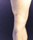 Meta-Analysis: Valgus Knee Bracing Helps Pain in Knee OA For patients with knee osteoarthritis