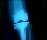 Knee OA One Year Post-ACL Reconstruction Common At one year post-anterior cruciate ligament reconstruction