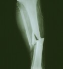 Wound Irrigation Pressure Doesn’t Affect Outcome For patients with an open fracture