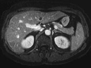 Drug-Eluting Chemoembolization No Better for Hepatocellular CA For patients with unresectable hepatocellular carcinoma