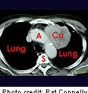 Lung-RADS Criteria Can Reduce False-Positive Result Rate Use of the American College of Radiology Lung Imaging Reporting and Data System classification system for low-dose computed tomography can reduce the false-positive result rate but also decreases sensitivity