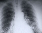 Statins Linked to Improved Survival in Lung Cancer Use of statins for a year before a diagnosis of lung cancer is associated with a 12 percent lower risk of cancer-specific mortality