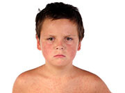 AAP Urges Parents to Vaccinate Children Against Measles The number of people infected with measles linked to the outbreak at Disney amusement parks in Southern California now stands at 70