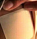 Lidocaine Patches Don’t Cut Pain After Robotic Cardiac Valve Sx For patients undergoing robotic cardiac valve surgery