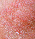 More Evidence Psoriasis and Depression Are Linked Regardless of severity