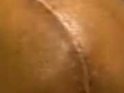 Non-Ablative Fractional Laser Could Treat Scar Contracture Treatment with a dual wavelength non-ablative fractional laser may result in the functional improvement of scar contractures