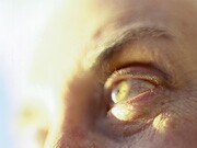 Carotenoids Help Reduce the Risk of Advanced AMD Carotenoids are associated with a long-term reduced risk of advanced age-related macular degeneration