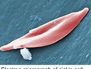 Hydroxyurea Underutilized for Patients With Sickle Cell Less than one-quarter of sickle cell anemia patients who should have been taking hydroxyurea within a year of their last pain crisis actually were taking the medication