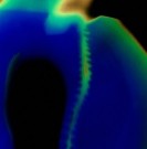 Early Surgery Tied to Increased Mortality in Polytraumatized For polytraumatized patients