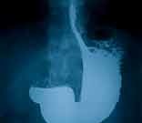 Novel Microendoscope Ups Accuracy of Esophageal Screening A novel