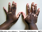 Confetti-Like Depigmentation May Predict Vitiligo Progression Confetti-like depigmentation may be a marker of rapidly progressing vitiligo