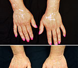 Drug for Rheumatoid Arthritis May Also Help Ease Vitiligo Researchers report that a drug for rheumatoid arthritis may be a promising treatment for vitiligo. The findings were published online June 24 in JAMA Dermatology.