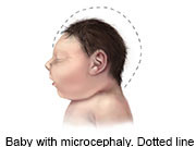 CDC: Zika Link to Microcephaly, Brain Damage Confirmed Zika virus is a definite and direct cause of microcephaly and other brain-related birth defects