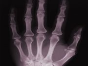 Early Therapy for Rheumatoid Arthritis May Slow Heart Disease Disease-modifying antirheumatic drug therapy for rheumatoid arthritis treatment also cuts cardiovascular disease risk