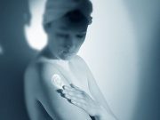 Some Lupus Erythematosus Cases Tied to Drug Exposure Some cases of subacute cutaneous lupus erythematosus and systemic lupus erythematosus are drug-induced