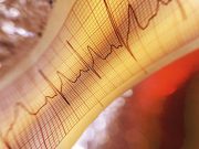 Impact of Psoriasis Explored for Hospital Outcomes of Acute MI Myocardial infarction events may occur earlier in life in patients with psoriasis