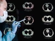Imaging Manifestations of E-Cig, Vaping Lung Injury Described Imaging manifestations of electronic cigarette or vaping product use-associated lung injury include an acute lung injury pattern exhibiting as multifocal ground-glass opacity and/or consolidation