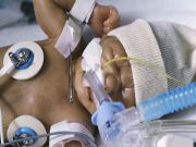 Skin Breaks Drop With Prolonged AL/CVL Use in Neonates Neonates with prolonged arterial line/central venous line use have fewer skin breaks and have significantly larger thalamic volumes early in life compared with those with restricted line use