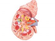 Removal Plus Transplant Surgery Feasible in Polycystic Kidney Disease Patients with large polycystic kidneys can have their diseased kidneys safely removed laparoscopically at the same time as their kidney transplant surgery