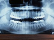 Periodontal Pathogens Linked to Atherosclerosis in RA