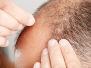 Disproportionality Signal Found for Suicidality in Finasteride Users ¿La Propecia podría aumentar el riesgo de suicidio de los hombres jóvenes?