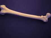 Vegans Have Increased Risk for Total, Main-Site Fractures