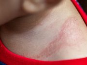 Vitamin D Supplementation May Aid Severe Dermatitis