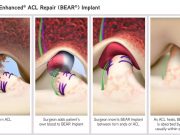 FDA Authorizes Marketing of ACL Implant