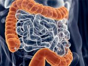 Hot Spots ID’d for Higher CRC Mortality in Younger Women