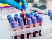 Hep C Testing, Identification Plummet During COVID-19