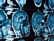 FUS Subthalamotomy Studied in Asymmetric Parkinson Disease