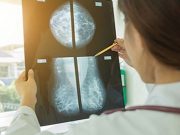 Mammography Guidelines Developed for Older Breast Cancer Survivors