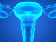 Levonorgestrel IUD Noninferior for Emergency Contraception Factors Identified Tied to Resultant Oophorectomy With Ophvarian Torsion