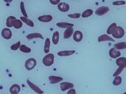 Gene Therapy for Sickle Cell Did Not Cause Patient’s Leukemia