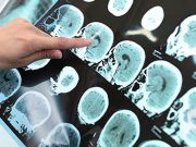 Head Injury Linked to Long-Term Risk for Dementia