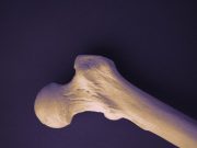 Bone Density Testing Low in Veterans With Kidney Stone Disease