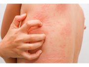 Children With Worse Atopic Dermatitis More Likely to Have Learning Disabilities